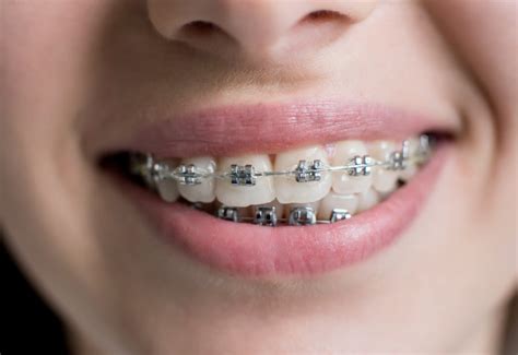 precio medio brackets metalicos|cuanto cuestan los brackets.